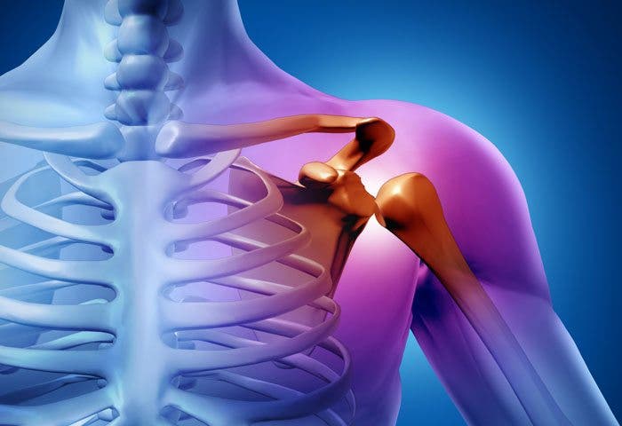 Tendinitis de biceps y hombros