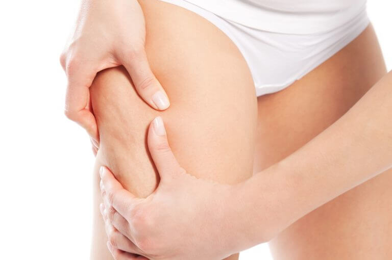 Celulitis: sus causas y los mejores tratamientos contra ella