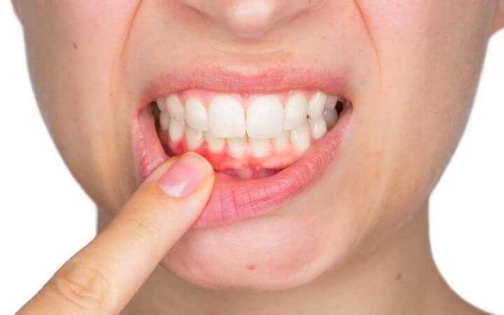 Los probióticos disminuyen el riesgo de caries