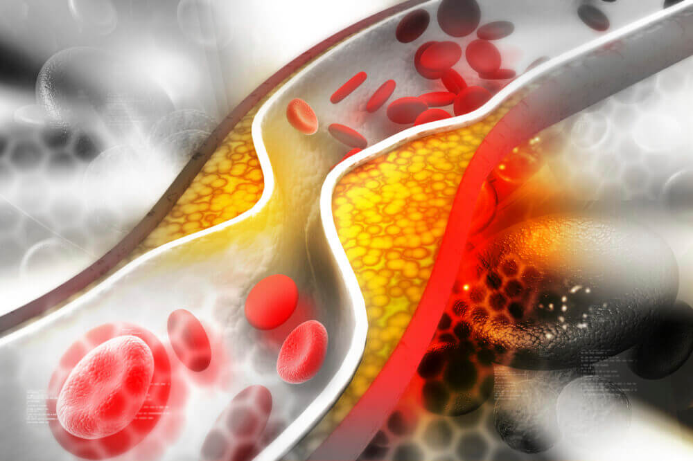 Cómo reducir los niveles de colesterol LDL en la sangre