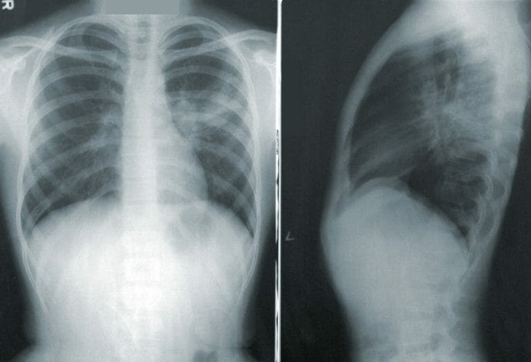 radiografía tórax neumonía